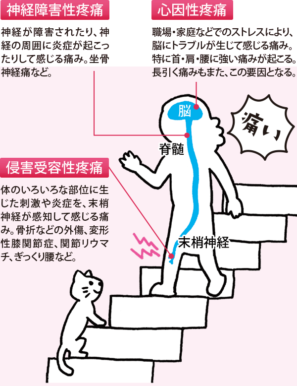 心因性疼痛:職場・家庭などでのストレスにより、脳にトラブルが生じて感じる痛み。特に首・肩・腰に強い痛みが起こる。長引く痛みもまた、この要因となる。神経障害性疼痛:神経が障害されたり、神経の周囲に炎症が起こったりして感じる痛み。坐骨神経痛など。侵害受容性疼痛:体のいろいろな部位に生じた刺激や炎症を、末梢神経が感知して感じる痛み。骨折などの外傷、変形性膝関節症、関節リウマチ、ぎっくり腰など。