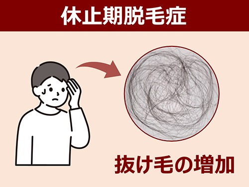 休止期脱毛症に 発毛成分「ミノキシジル」が有用な可能性を見出す