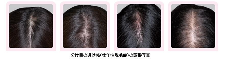 人には聞きづらい女性の髪悩み「分け目の透け感」実態調査