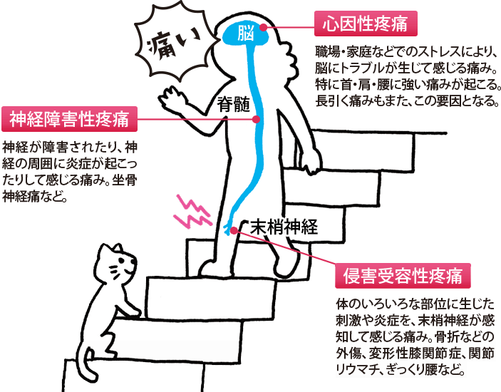 心因性疼痛:職場・家庭などでのストレスにより、脳にトラブルが生じて感じる痛み。特に首・肩・腰に強い痛みが起こる。長引く痛みもまた、この要因となる。神経障害性疼痛:神経が障害されたり、神経の周囲に炎症が起こったりして感じる痛み。坐骨神経痛など。侵害受容性疼痛:体のいろいろな部位に生じた刺激や炎症を、末梢神経が感知して感じる痛み。骨折などの外傷、変形性膝関節症、関節リウマチ、ぎっくり腰など。 