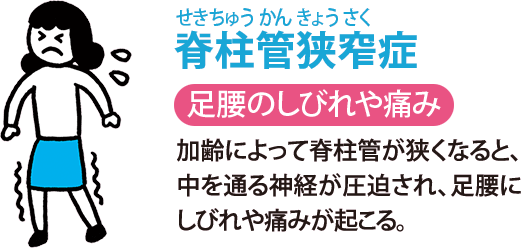 脊柱管狭窄（せきちゅうかんきょうさく）症:足腰のしびれや痛み　加齢によって脊柱管が狭くなると、中を通る神経が圧迫され、足腰にしびれや痛みが起こる。